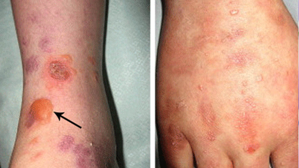 Dermatology